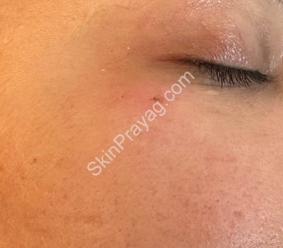 Mole Removal