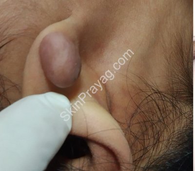 Ear keloid removal
