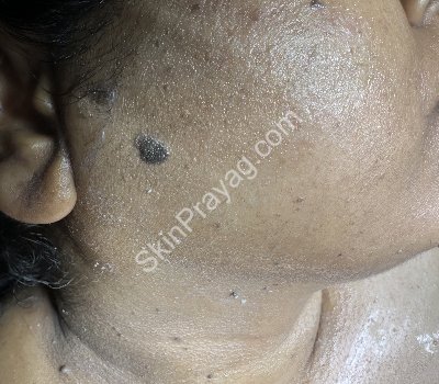 Before removal of skin tags, seborrheic keratoses