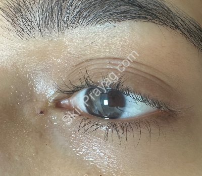 After milia removal