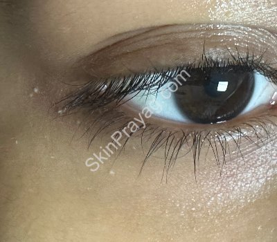 Before milia removal