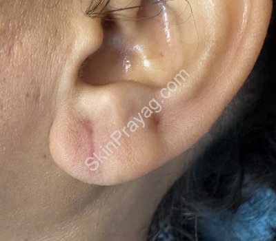 After earlobe repair